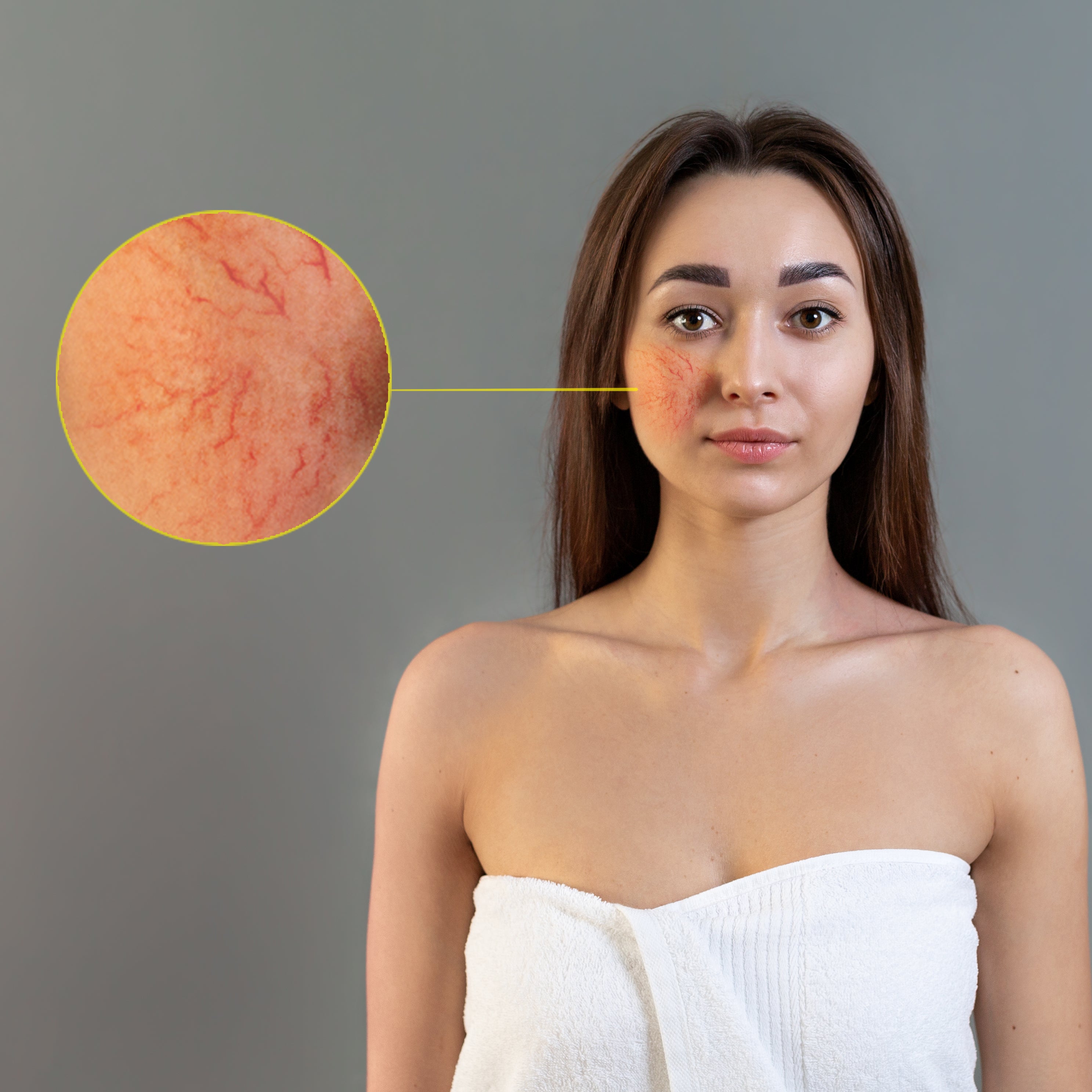 Rosacea