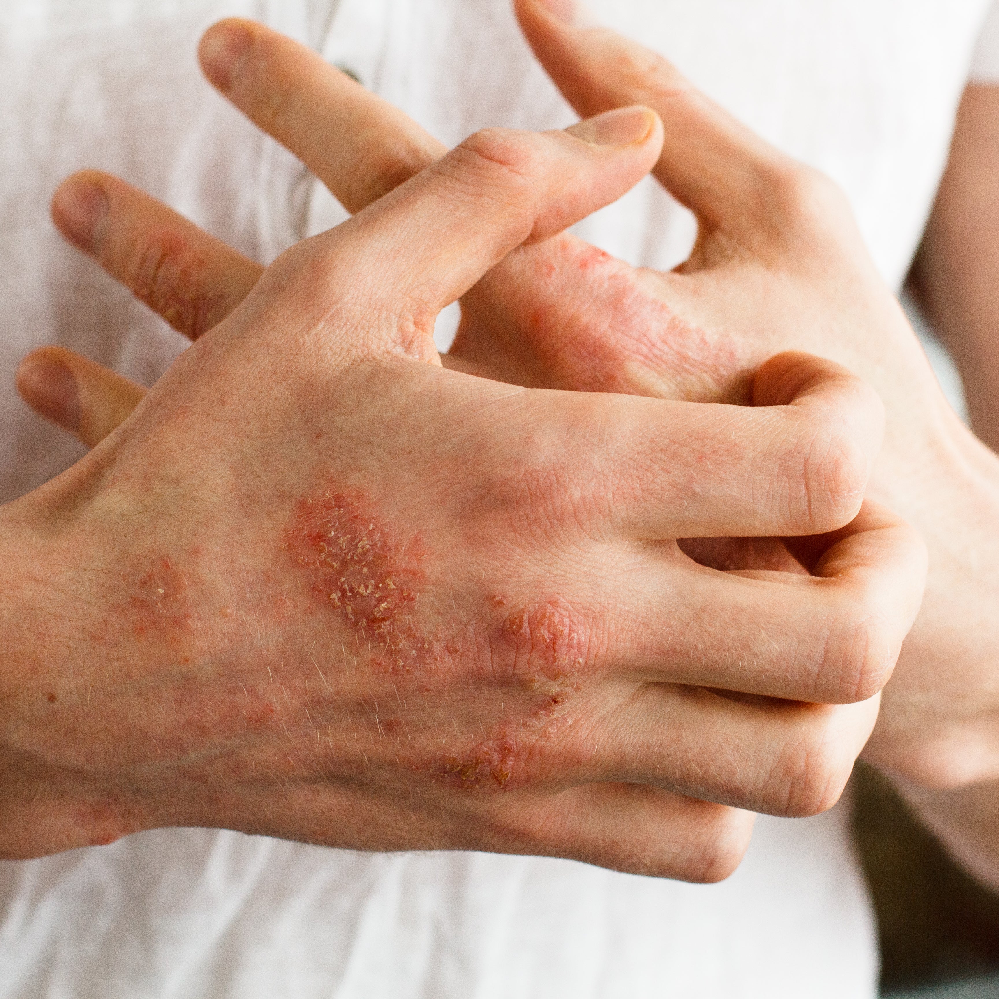 Eczema